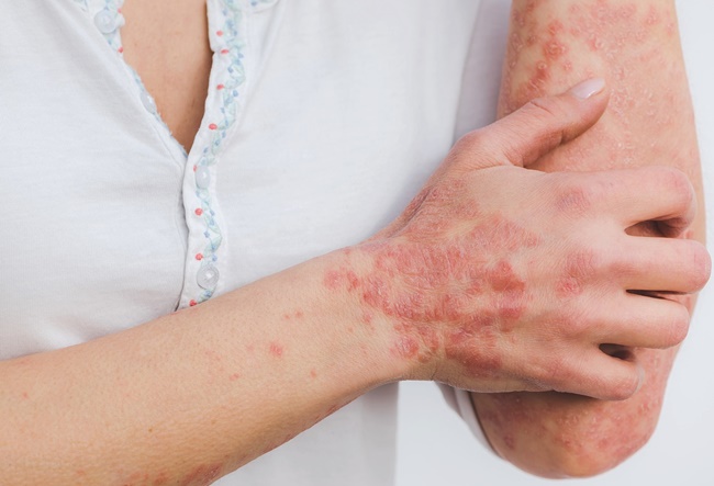 psoriasi da stress